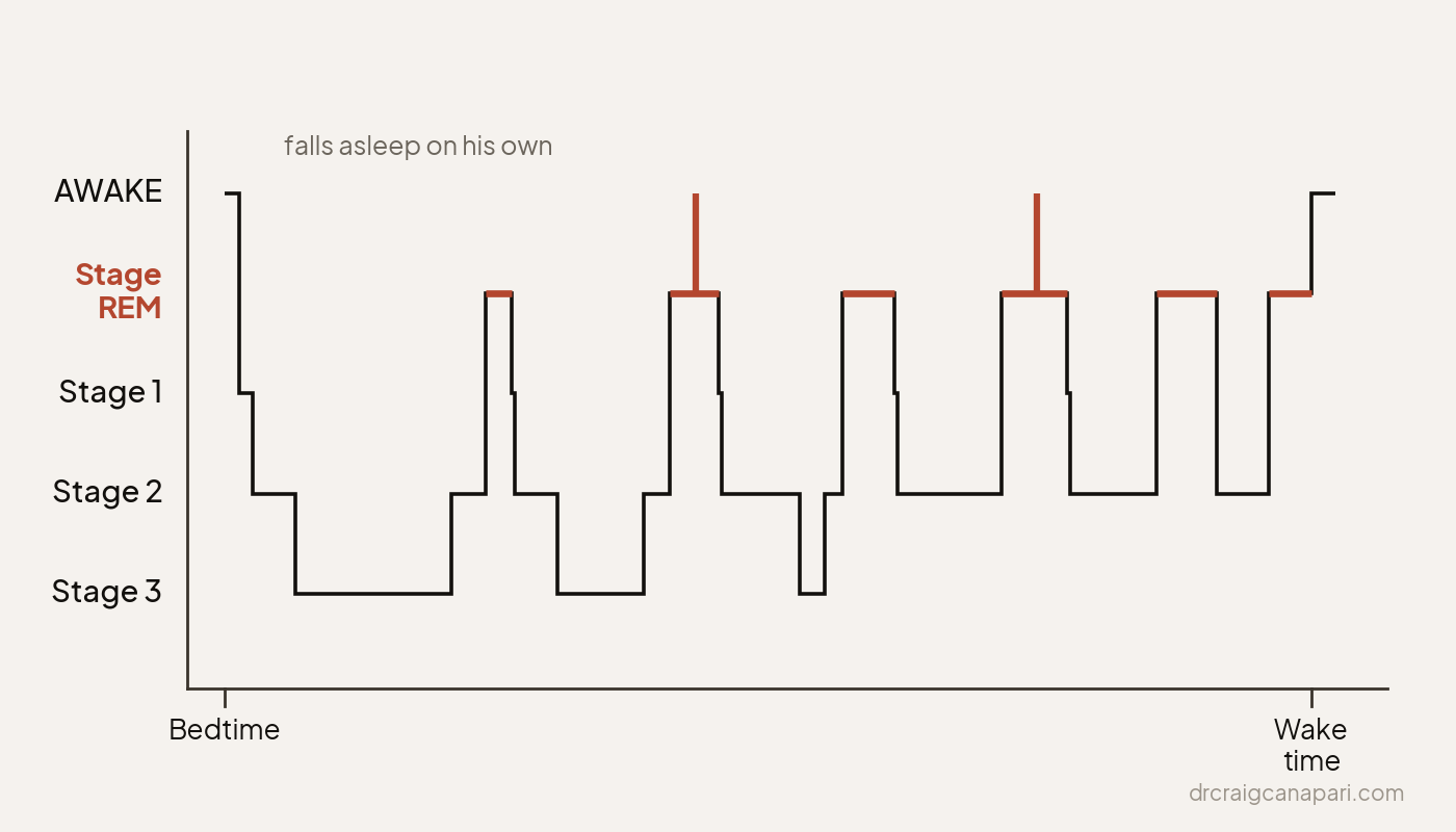 Hypnogram of a normal night for a toddler who falls asleep on his own. After a long stretch of deep Stage 3 sleep early in the night, he cycles between Stage 2 and REM sleep, with two brief awakenings out of REM, and wakes in the morning.