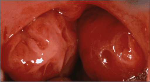 These tonsils may be causing a problem.