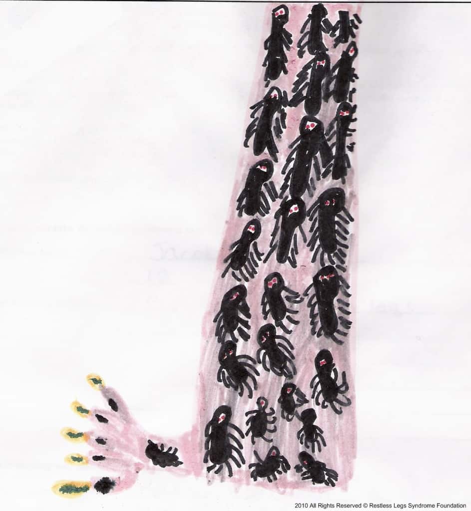 Child with restless leg drawing showing ants on skin